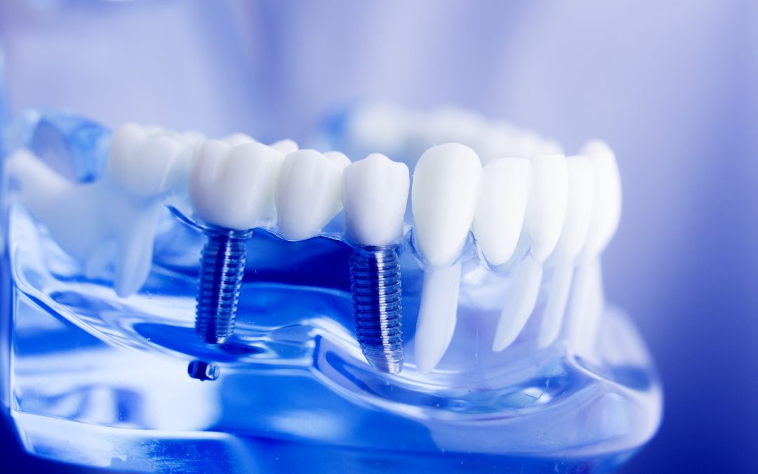 What To Expect After Dental Implant Surgery
