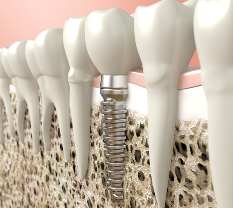 dental implants in innisfil