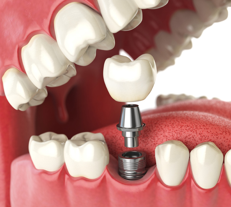 dental implants near you