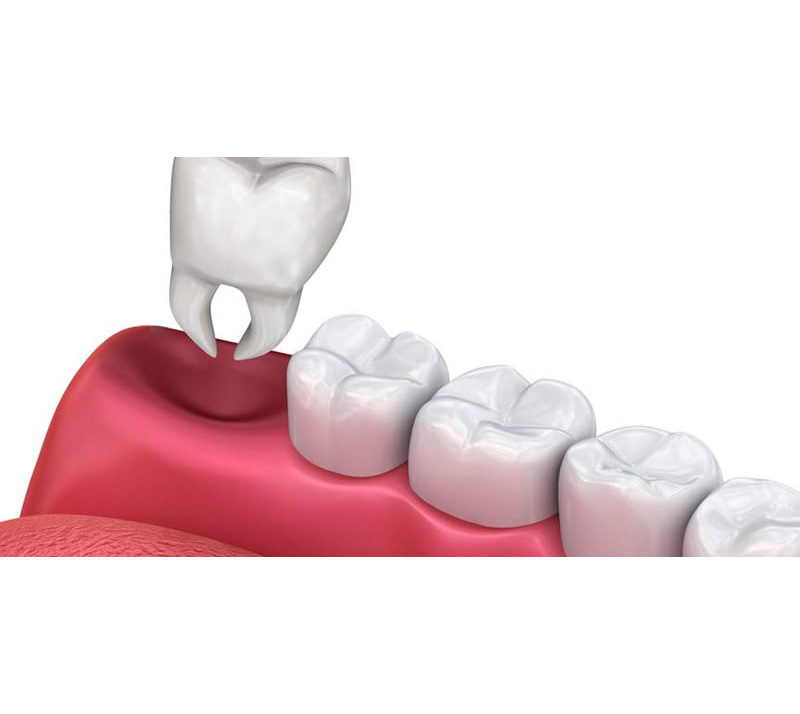 teeth extractions in innisfil