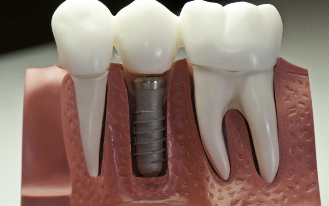 do-dental-implants-last-a-lifetime
